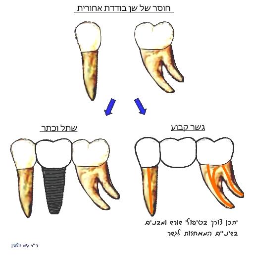 פתרונות לשן אחורית חסרה:  שתל בודד או גשר 3 שיניים